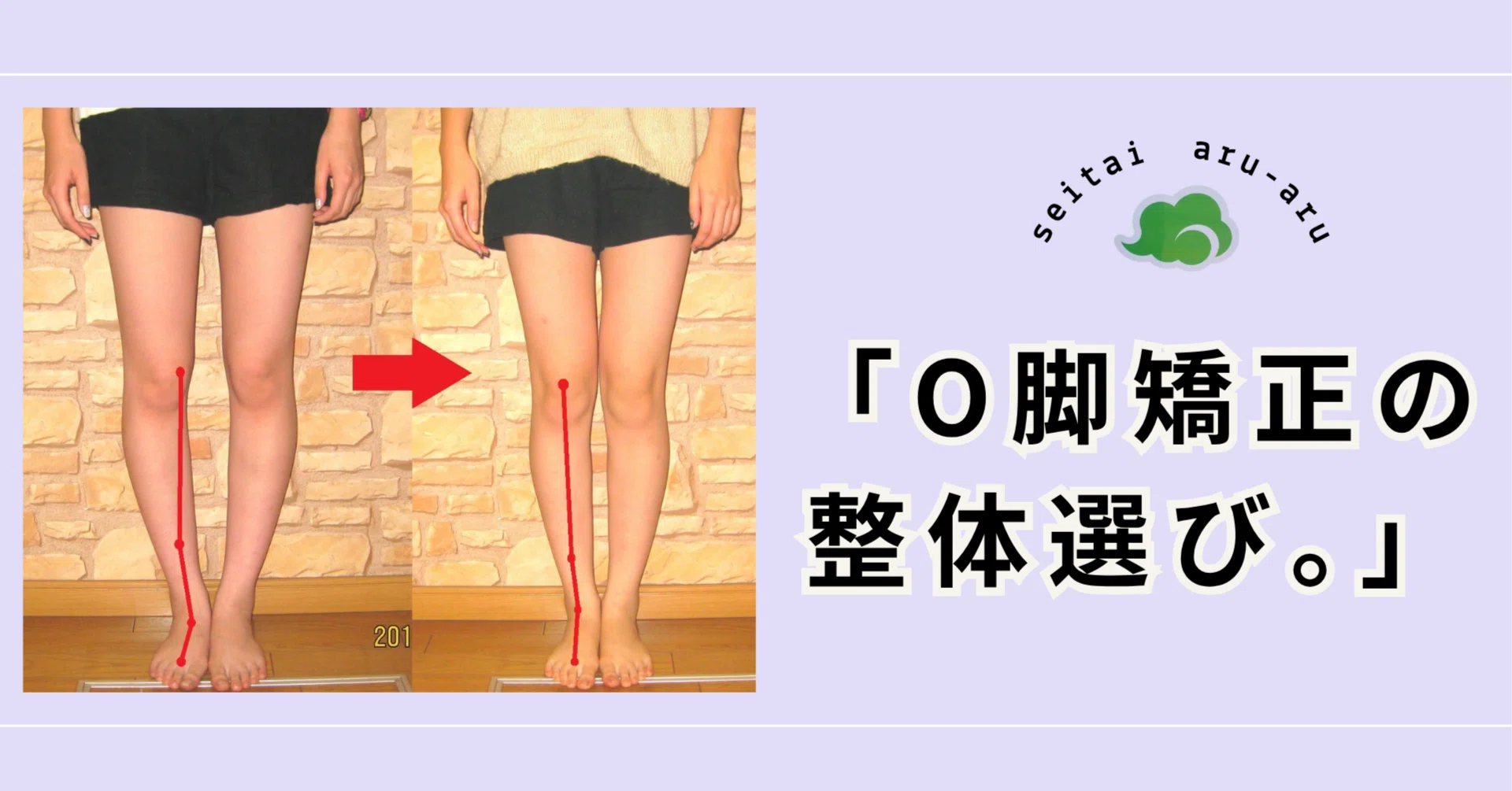 O脚は本当に全員が治るのか？18年の現場データから語る「改善できる
