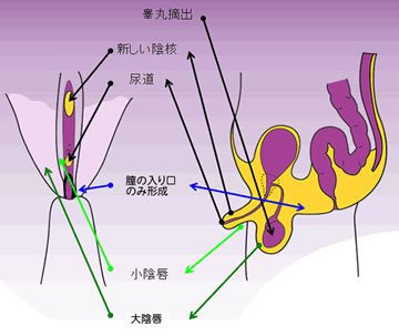 005 膣を作らないmtf手術でも性別変更は可能ですか バンコク在住医療コディネーター Note
