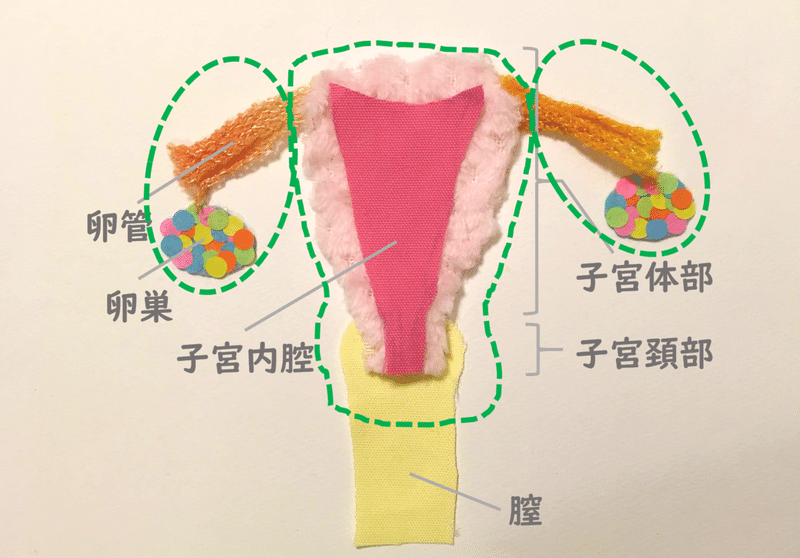 準広汎子宮摘出