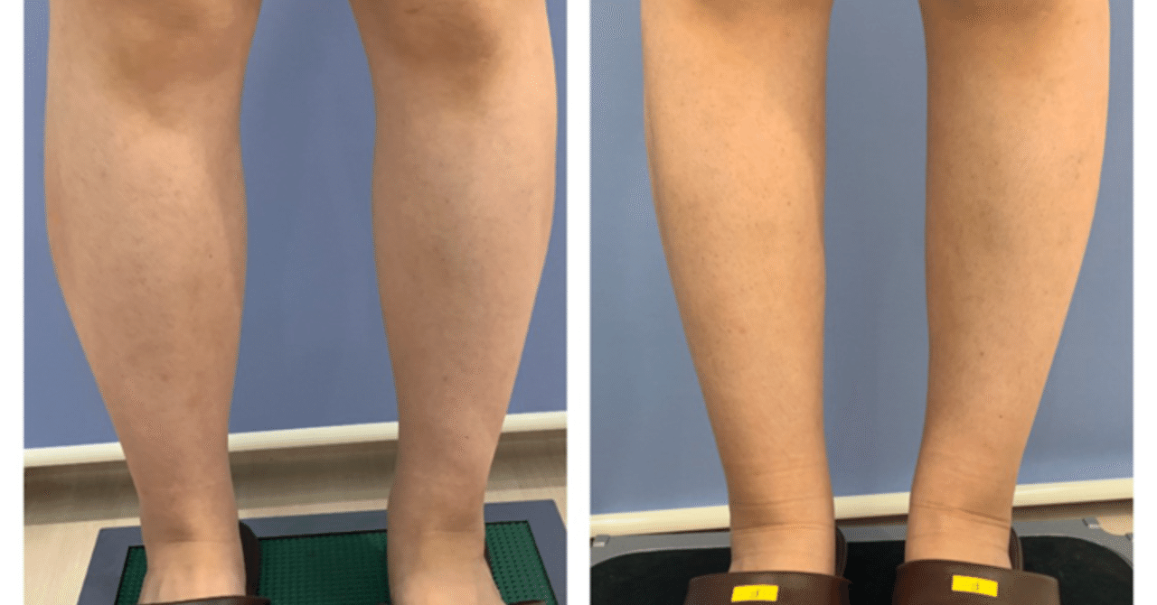 下半身の脂肪吸引もお得なモニター様募集中です 湘南美容クリニック多田彩子 Note