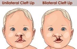 口蓋裂はキレイになる】#16｜みきてぃ