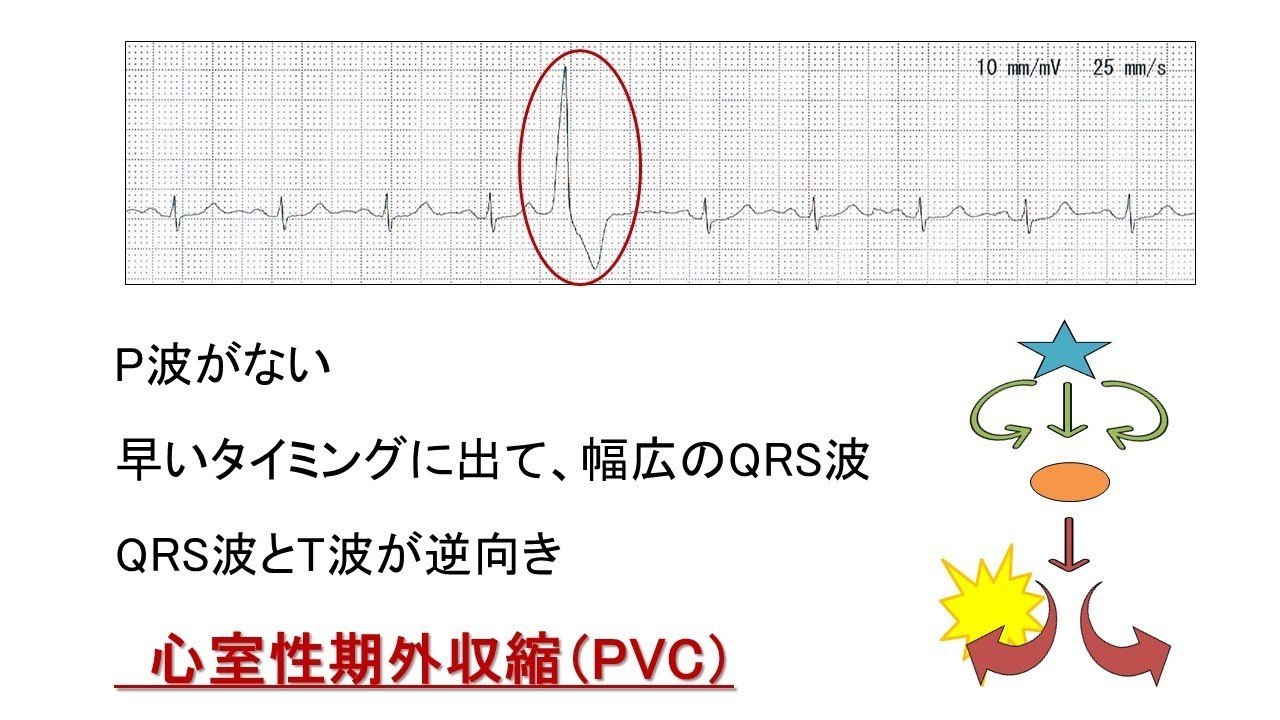 これはpvcですか 心電図検定1級ドタバタ検査技師まえた Note