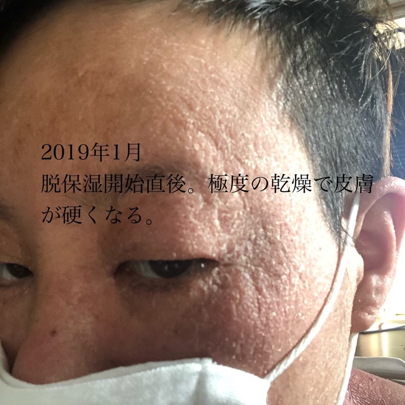 写真で振り返るアトピーと闘った1年間 脱ステロイド 脱保湿 色々試したけれど 大切なのはたった一つ 自分で決めることだった 長尾 瞳 Note