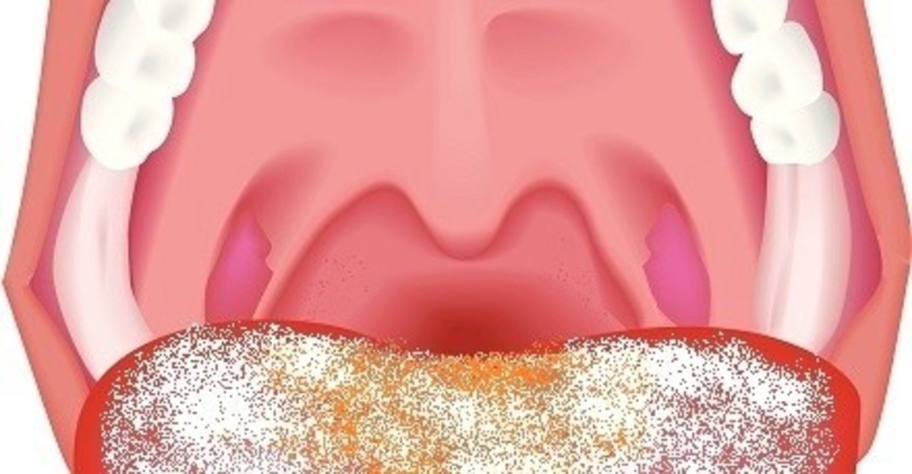 あなたの 舌苔 が取れない理由を知っていますか Uebayashi Note