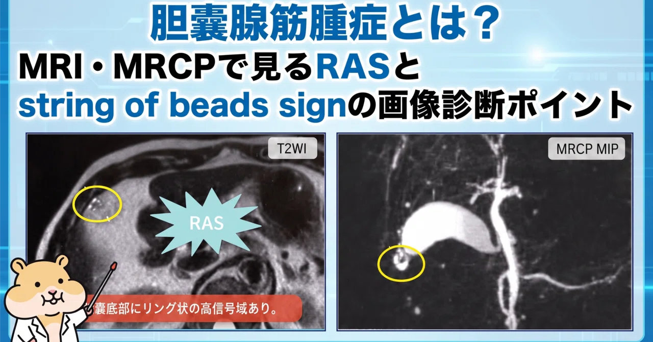 胆嚢腺筋腫症とは？MRI・MRCPで見るRASとstring of beads signの画像診断ポイント｜とっとこ画像診断太郎
