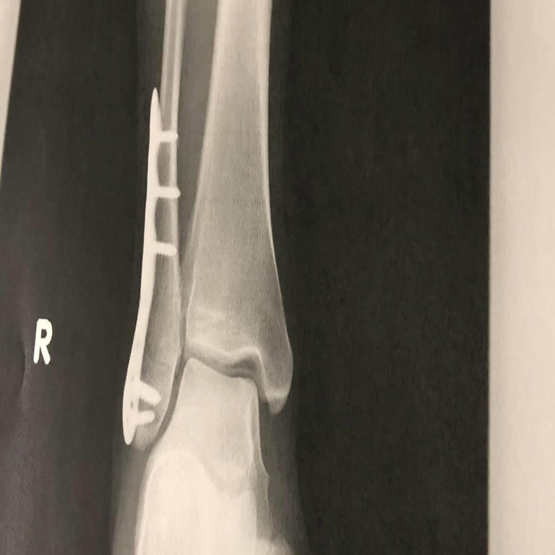 柔整師自身が骨折した日記vol.5｜大榎良則