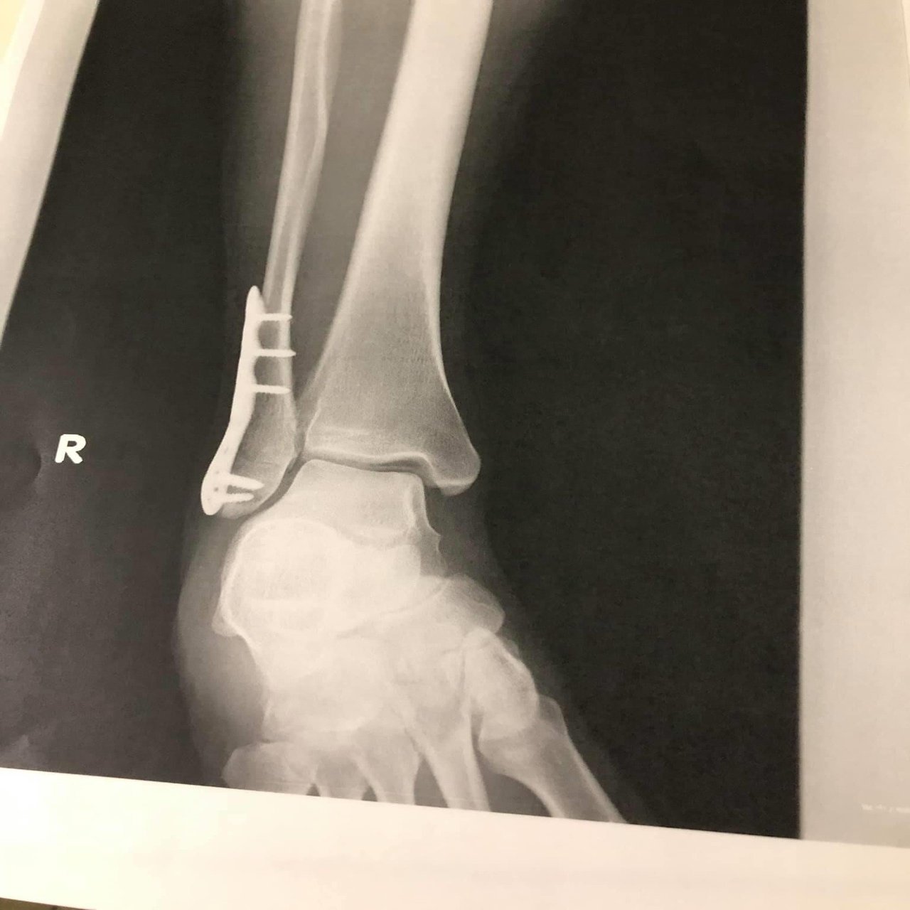 柔整師自身が骨折した日記vol.5｜大榎良則