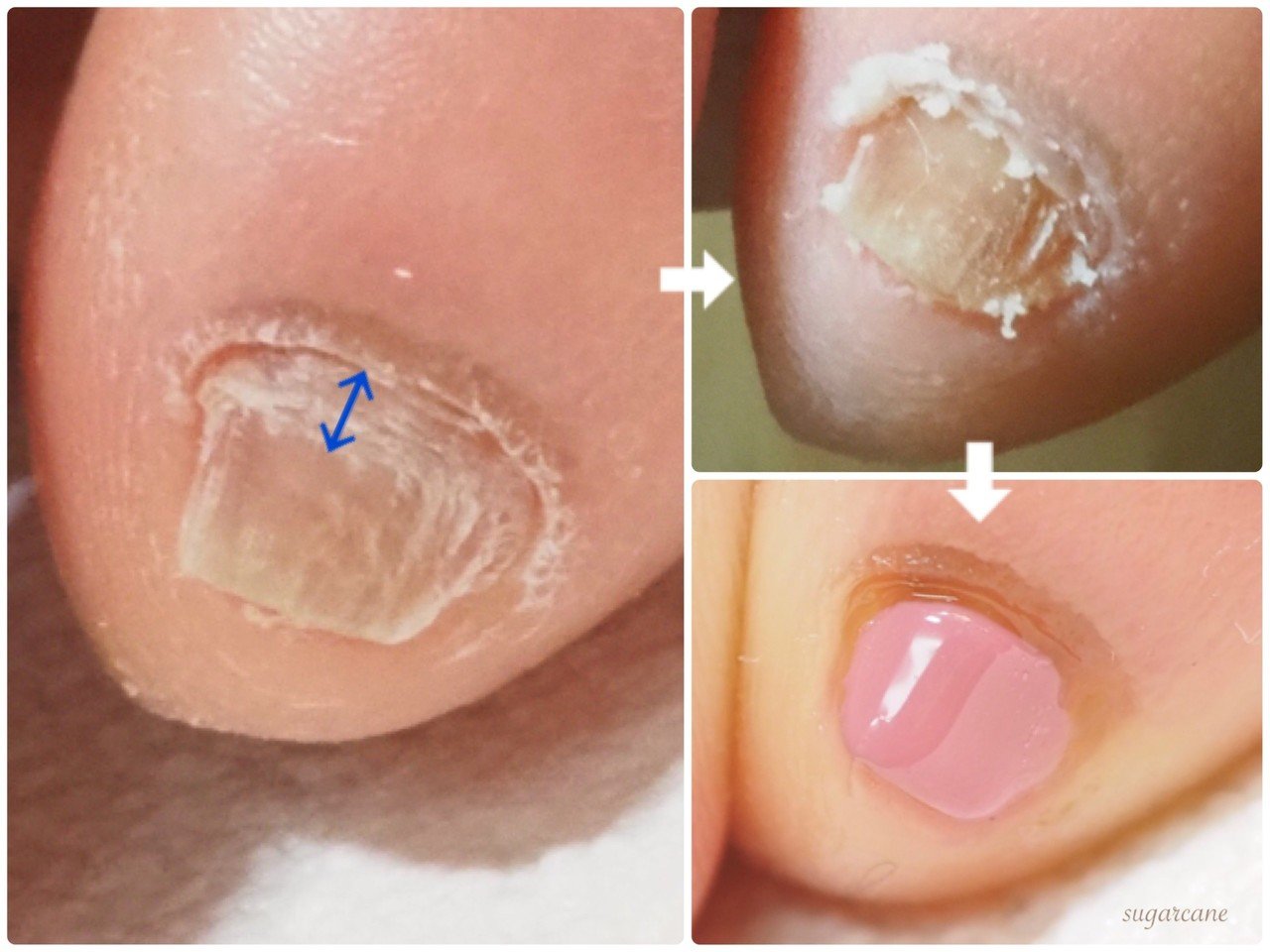 小指のお悩み Nailsalon Sugarcane Note 小指のお悩み Nailsalon Sugarcane Note