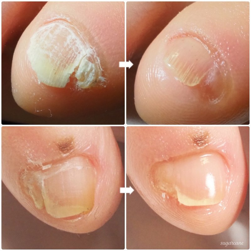 小指のお悩み Nailsalon Sugarcane Note