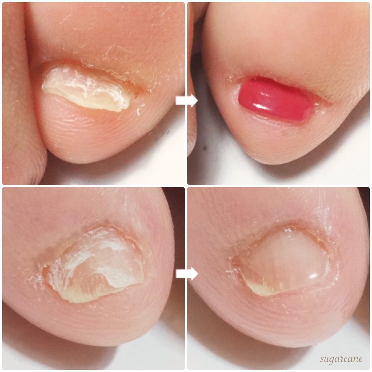 小指のお悩み Nailsalon Sugarcane Note 小指のお悩み Nailsalon Sugarcane Note