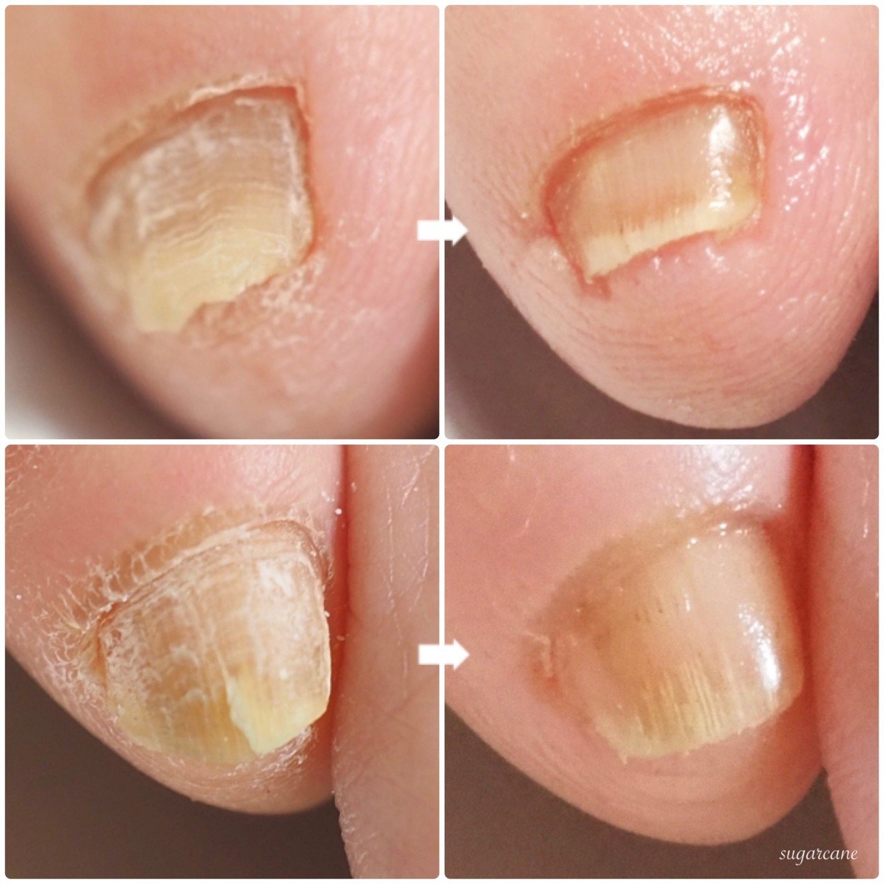 小指のお悩み Nailsalon Sugarcane Note 小指のお悩み Nailsalon Sugarcane Note