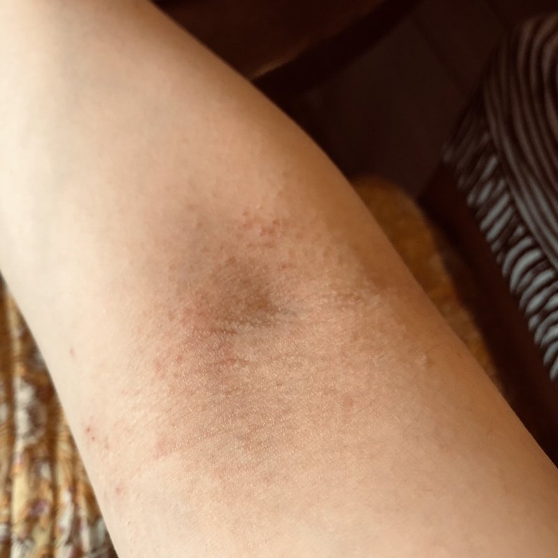 35歳でアトピーと診断されまして 写真で回復の過程を報告します イトウ カヌレ Note