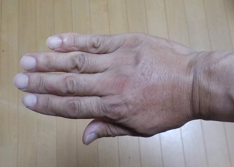 ハチに刺されました 金木犀 キンモクセイ Note ハチに刺されました 金木犀 キンモクセイ Note