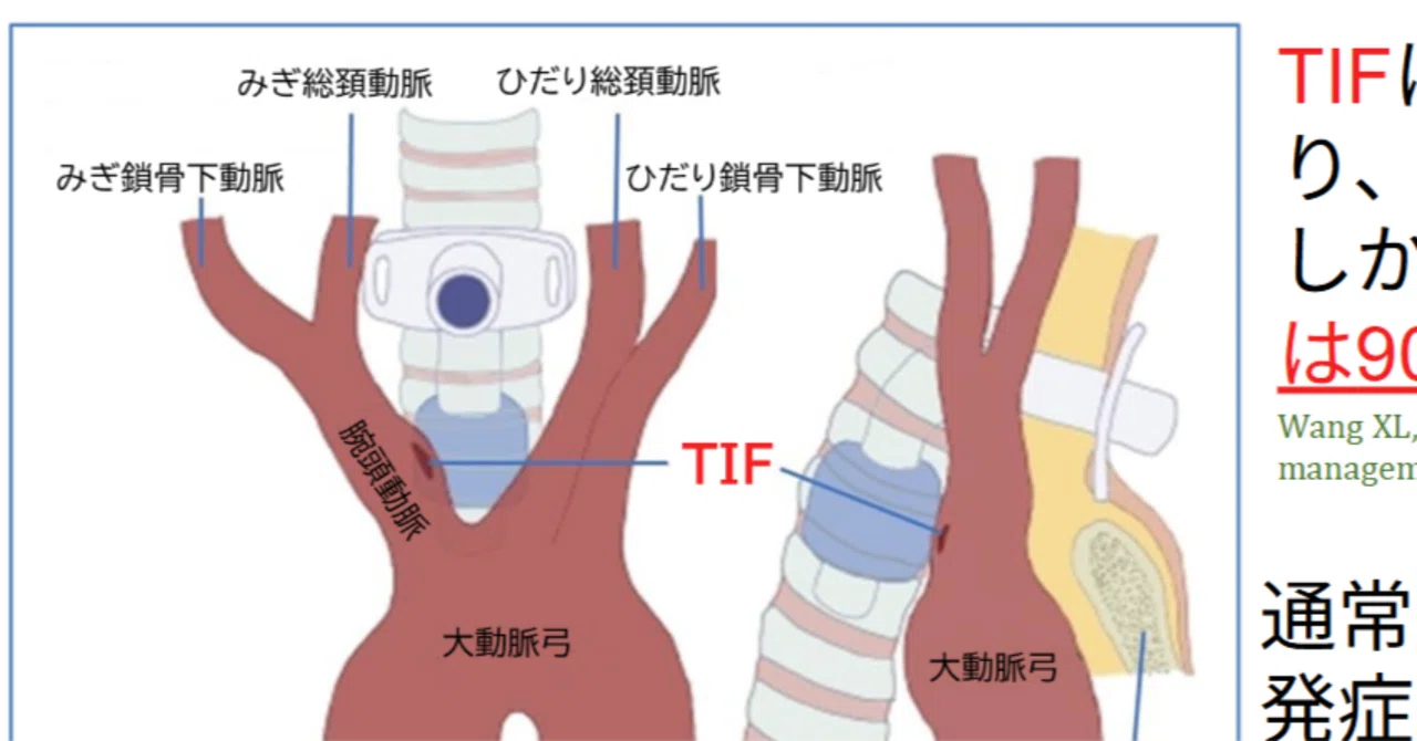 無料ワードファイル・無料要約スライド「気管切開口管理に関する