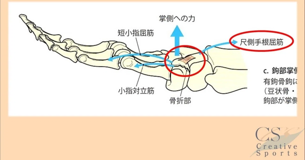Vol 有鈎骨骨折について バッティング動作から考える 3995文字 動画 11本 野球動作指導baseball Station筑後 野球専門理学療法士久保田正一 Note