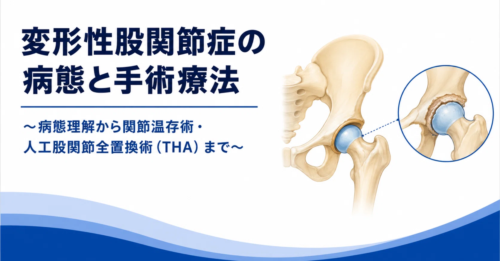 変形性股関節症の評価・理学療法・手術療法完全ガイド― 病態理解から