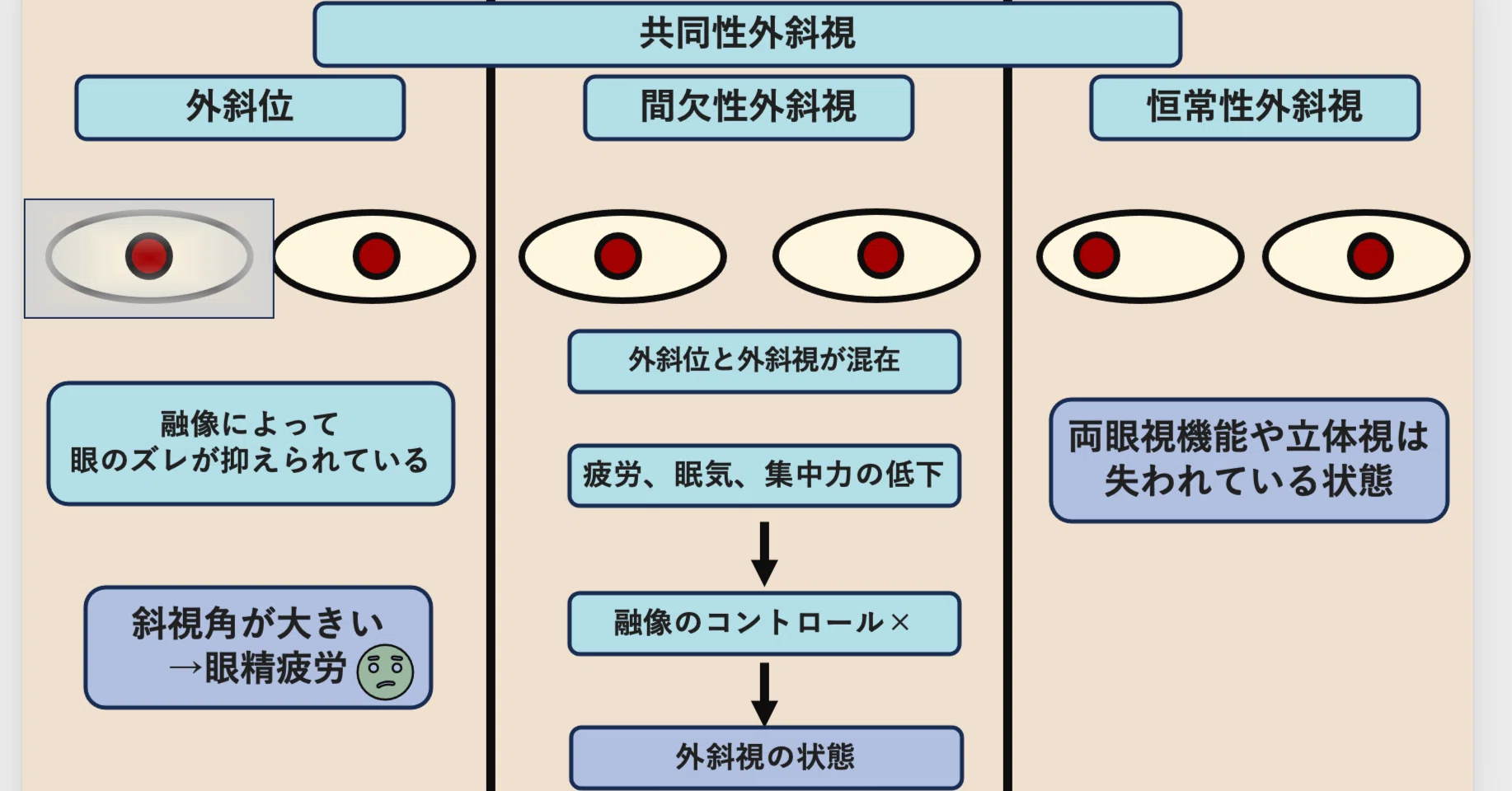 間欠 性 外 斜視