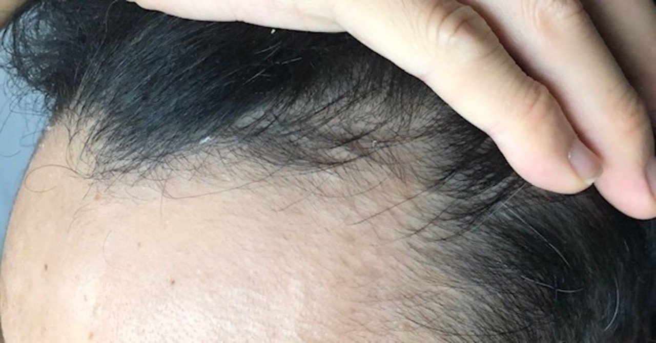 はげを食い止める男の話 ミスターノーaga ベジータロー Note