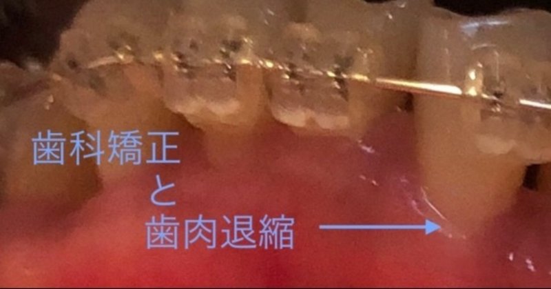 歯科矯正🦷と歯肉退縮😫💦