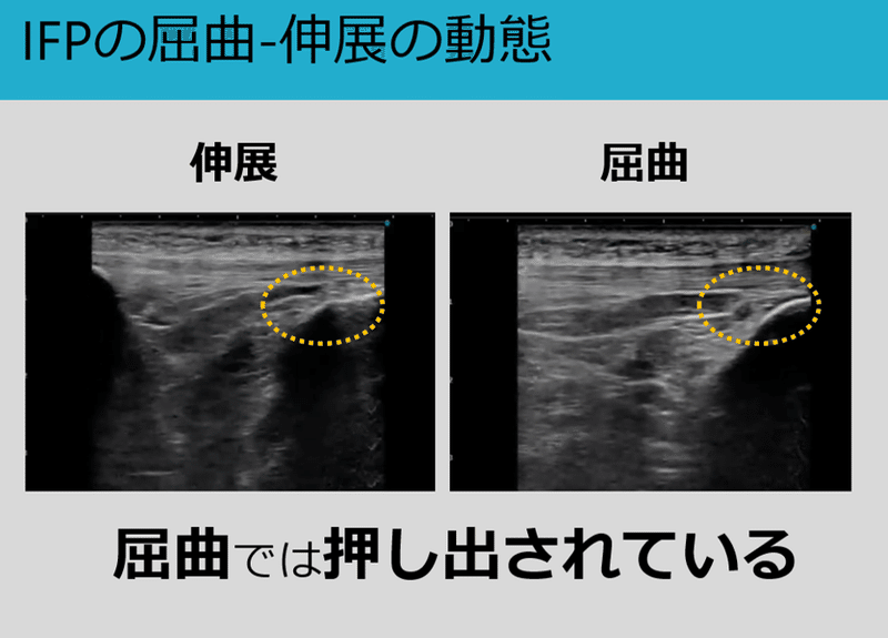Ifpの治療 徒手と物理療法 Y K Note Ifpの治療 徒手と物理療法 Y K Note