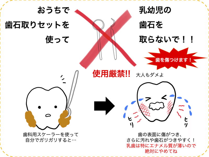 乳幼児期にみられる歯石とその予防策 子育て歯みがきレシピvol 13 子育て歯みがきレシピ Note