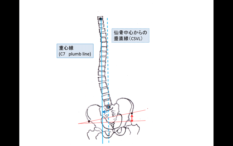 脚長差