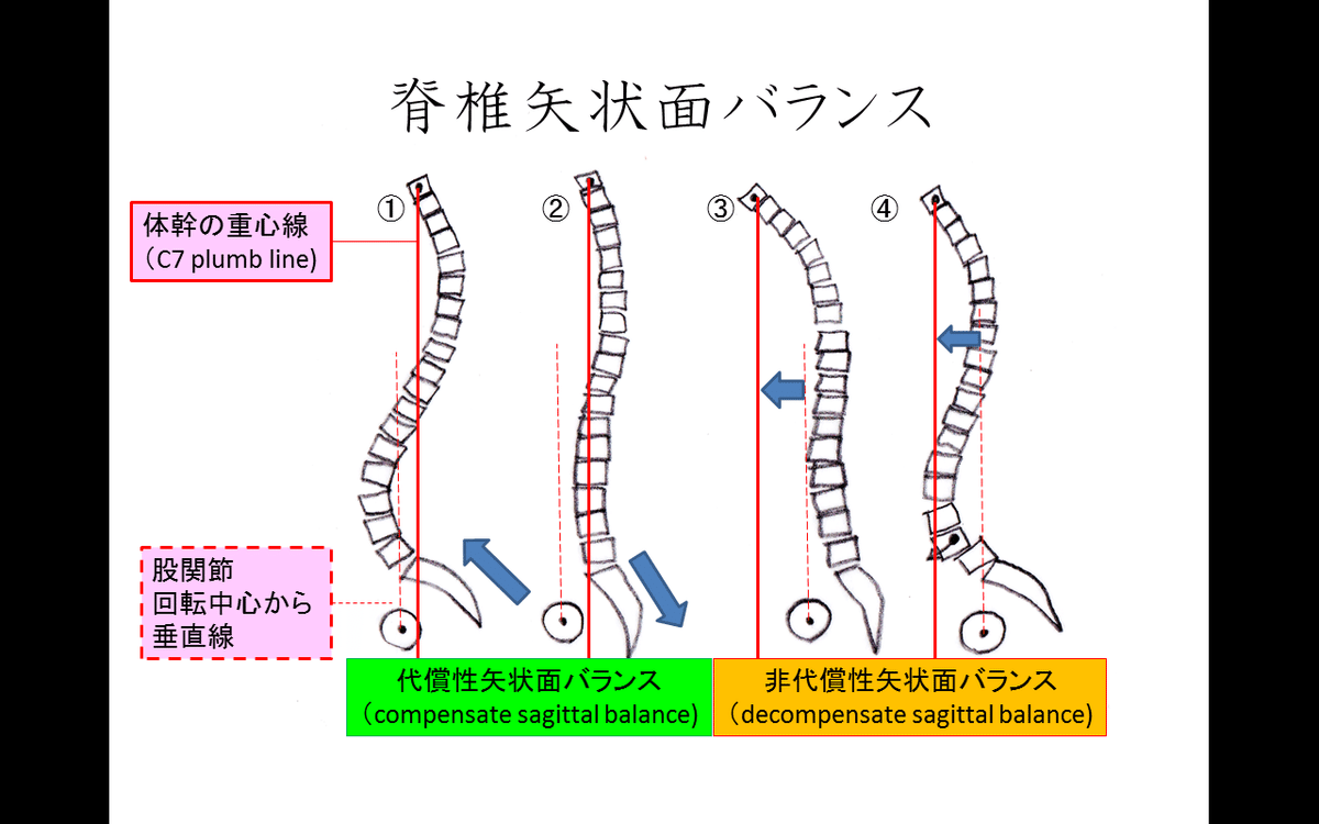 Hip-spine syndrome～骨盤帯から脊柱アライメントを考える～｜Lee