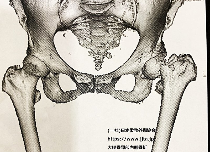 大腿骨頚部骨折2資料