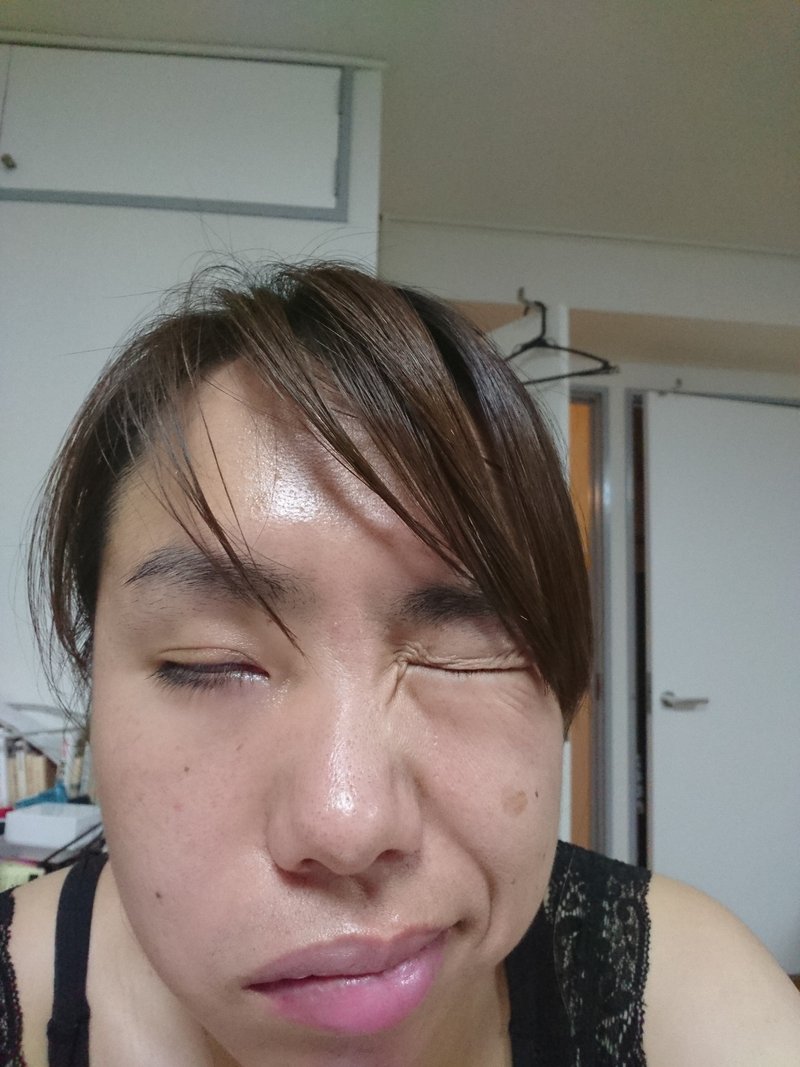 症候群 ハント