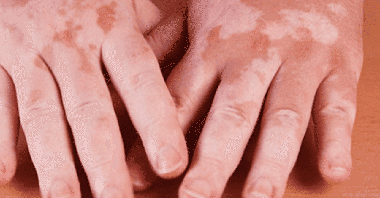 belirtileri ve bitkisel tedavi