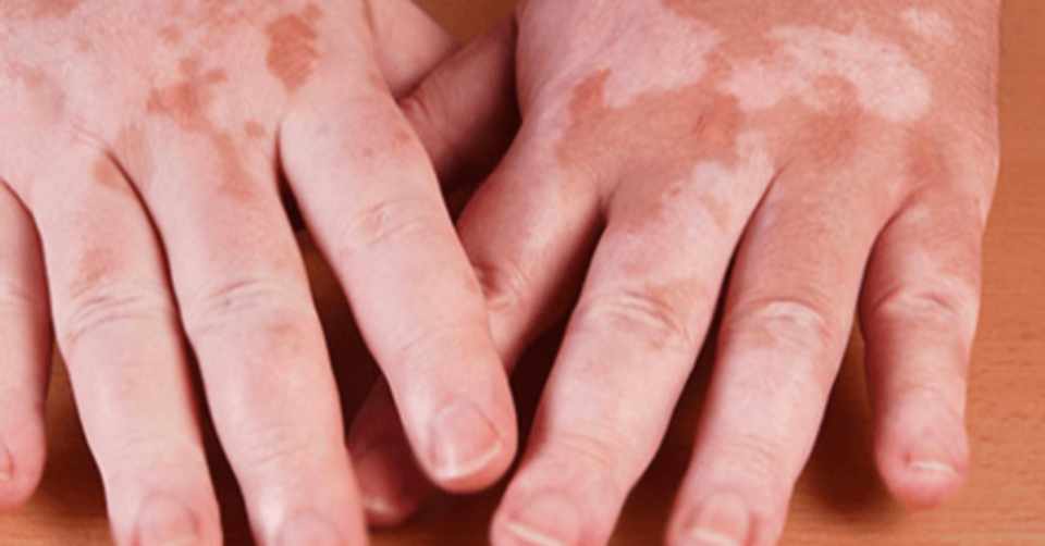 Vitiligo Hastaligi Nedir Belirtileri Ve Bitkisel Tedavi Begonya Note