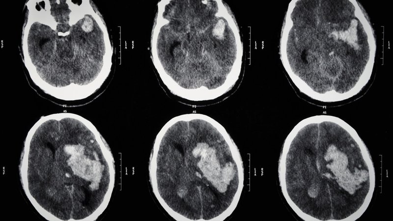 脳卒中ガイドラインで学ぶsa 高血圧性脳出血の手術適応は？