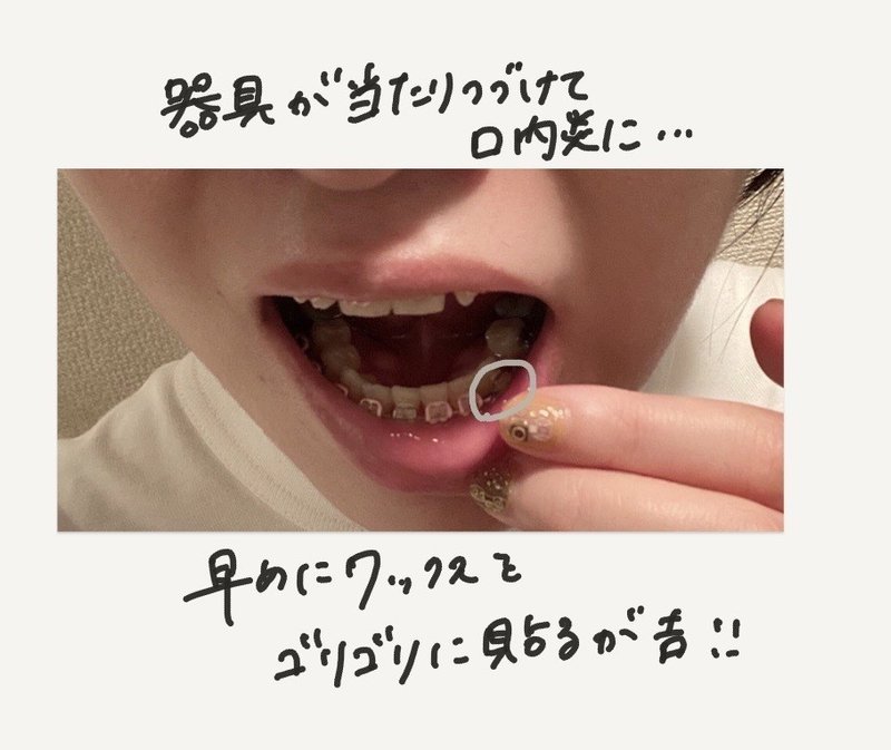 口内炎とqol ワックスの大事さを悟る 大人の歯列矯正 8ヶ月目 Miki Sato Note