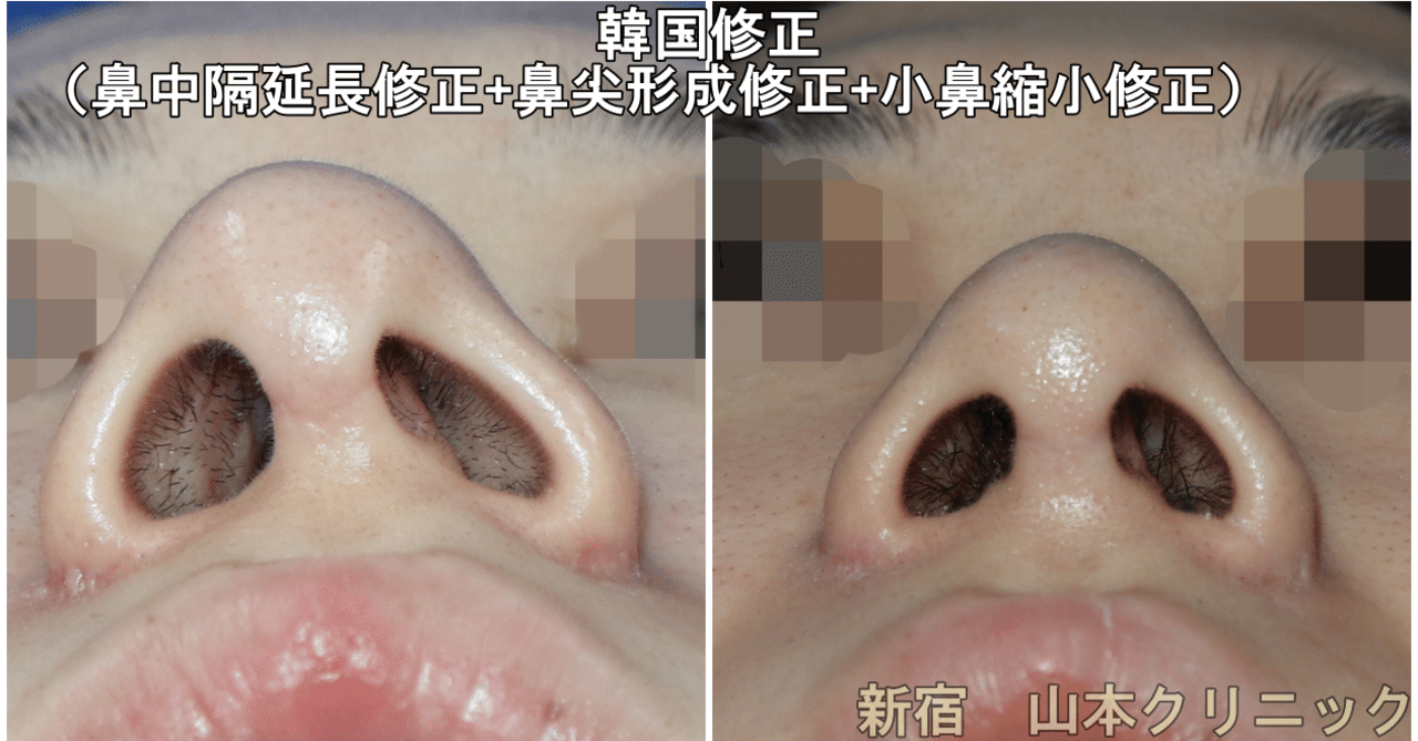 鼻修正手術は 腫れる 新宿 山本クリニック Note