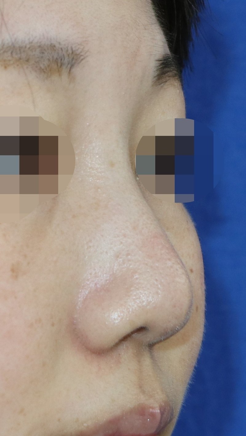 鼻プロテーゼ シリコン 抜いても変わらないって そんなに小さいの 他院修正術 新宿 山本クリニック Note 鼻プロテーゼ シリコン 抜いても変わらないって そんなに小さいの 他院修正術 新宿 山本クリニック Note