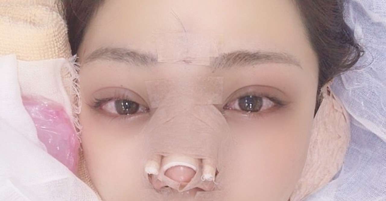 鼻整形レポート まるまるこの備忘録 Note