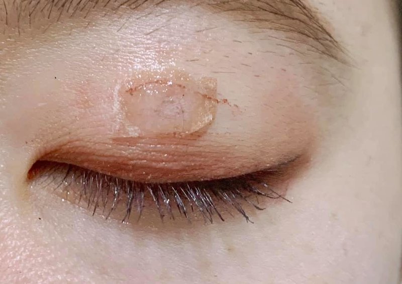 まぶたのほくろをとった話 アユミ Note