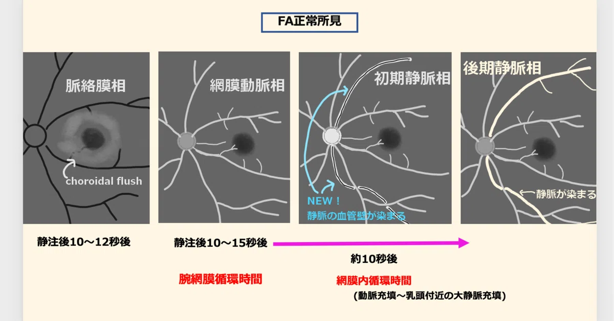 蛍光眼底造影検査（FA・IA）の基礎と読影・病態のまとめ｜眼科医エスロト