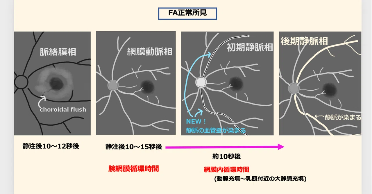 蛍光眼底造影検査（FA・IA）の基礎と読影・病態のまとめ｜眼科医エスロト