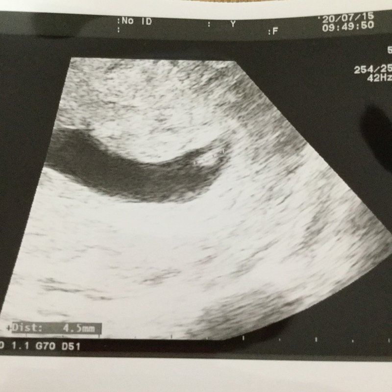 6w1d Et27フライング心拍確認 にこ天使ママ Note