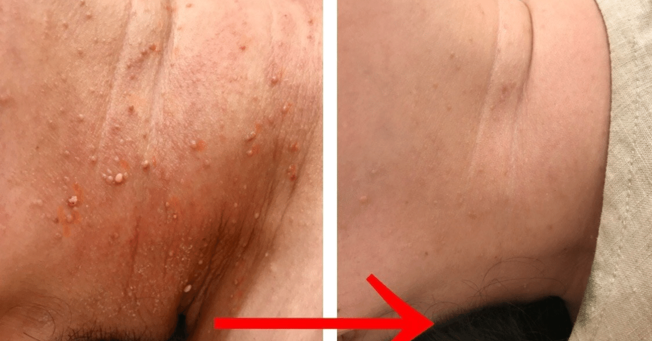 首イボ治療 Flalu フラルクリニック Note 首イボ治療 Flalu フラルクリニック Note