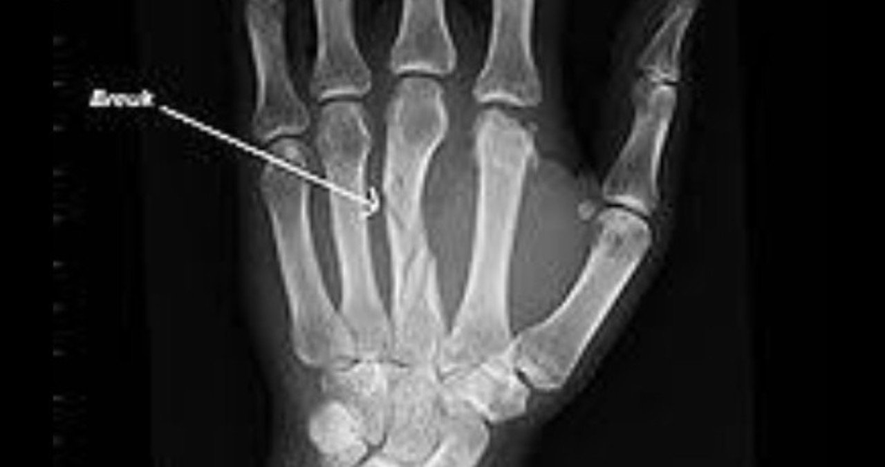 硬い巻藁を叩いたら拳の骨が強くなり Ko率が上がる という幻想 トシ 時々バイク旅 Note 硬い巻藁を叩いたら拳の骨が強くなり Ko率が上がる という幻想 トシ 時々バイク旅 Note