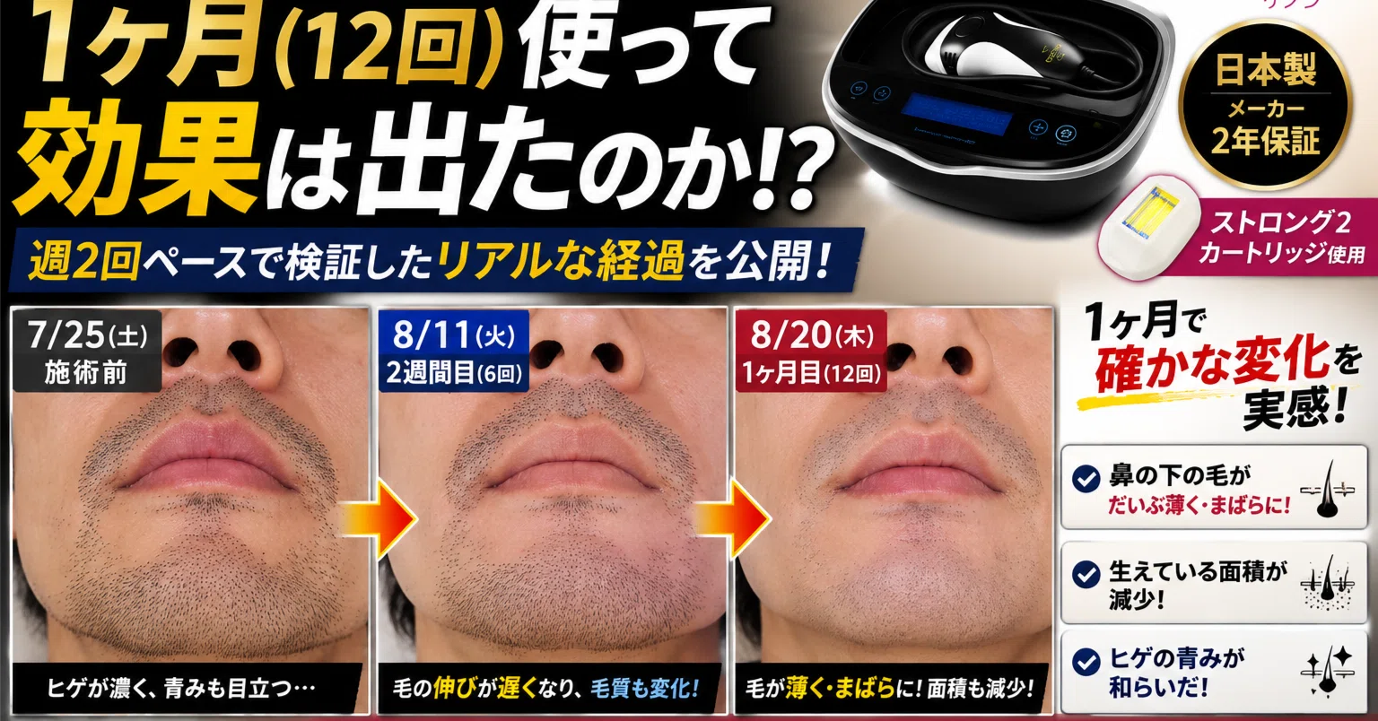 写真比較】ケノンをヒゲ脱毛に1ヶ月使ってみた効果！12回照射で変化は