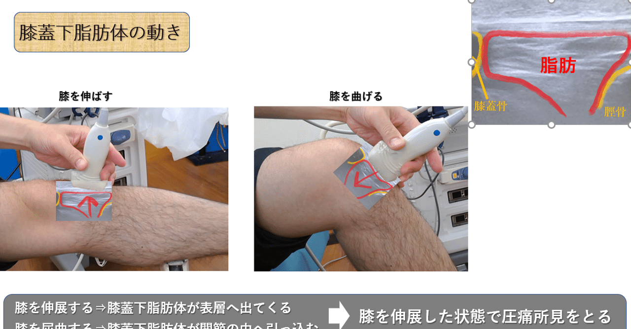 膝関節 第3回 膝蓋下脂肪体について 上田浩司 理学療法士 Note 膝関節 第3回 膝蓋下脂肪体について 上田浩司 理学療法士 Note