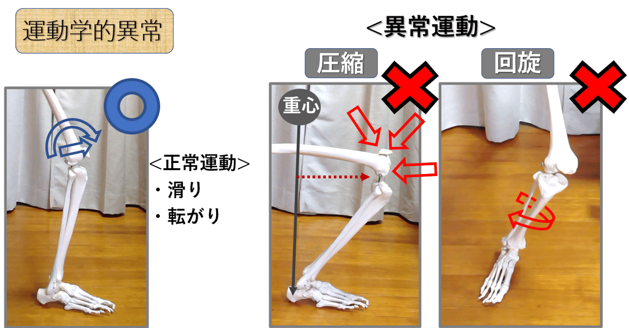 膝関節 第2回 《運動学的異常 回旋2》｜上田浩司（理学療法士）