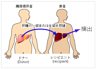 臓器移植