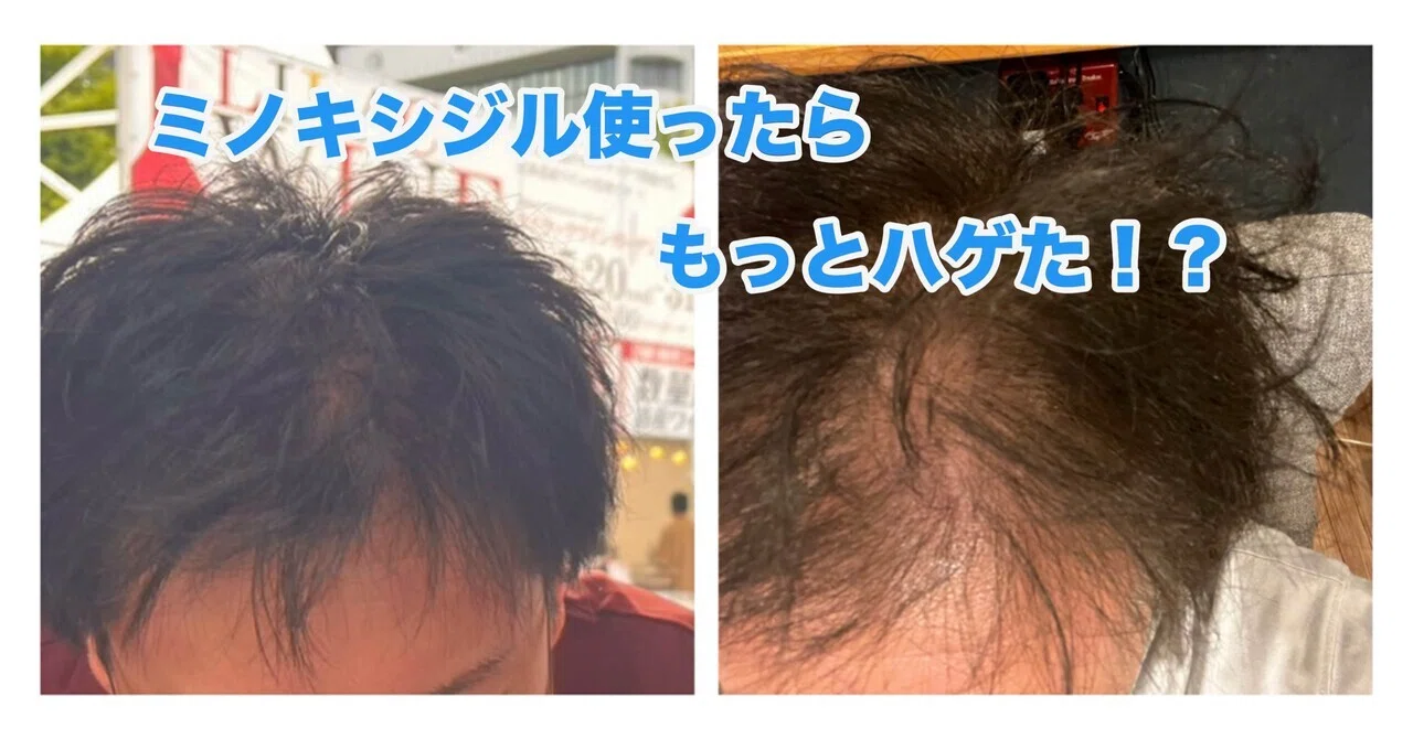 僕の育毛日記:ミノキシジルは本当に効くのか？(7月分)｜kuron T