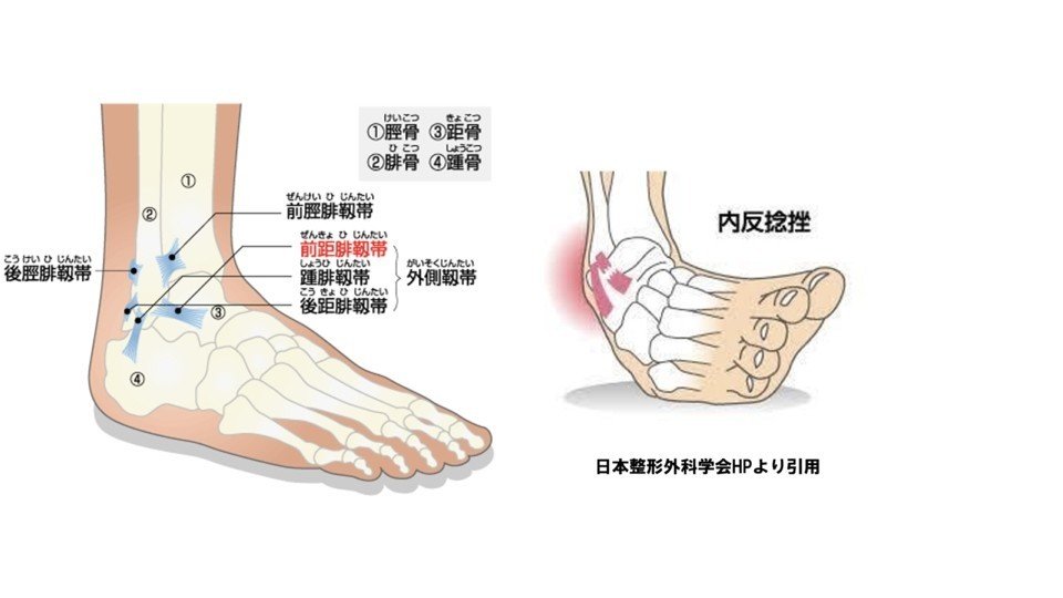 足関節捻挫.pptx 2.003