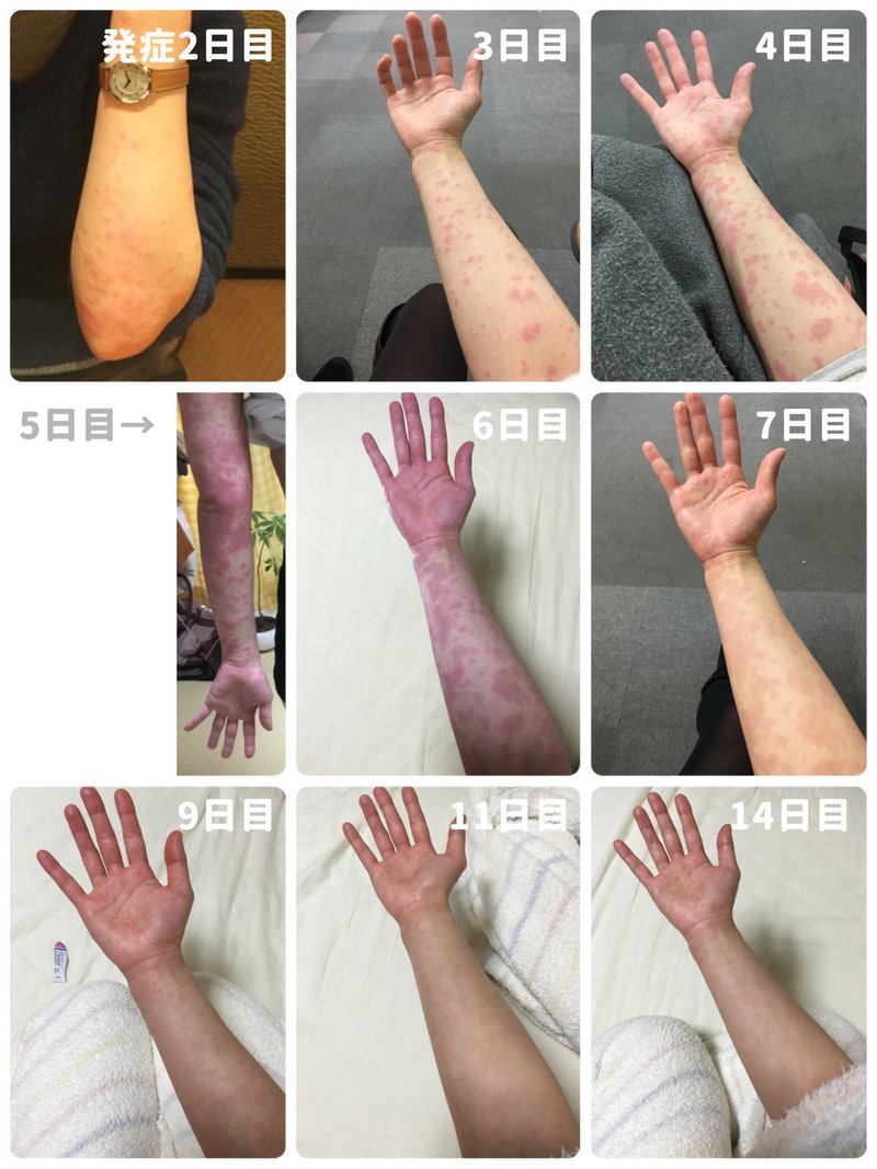 ピロリ菌除菌薬による重症薬疹で死にかけたお話 わなみん Note ピロリ菌除菌薬による重症薬疹で死にかけたお話 わなみん Note