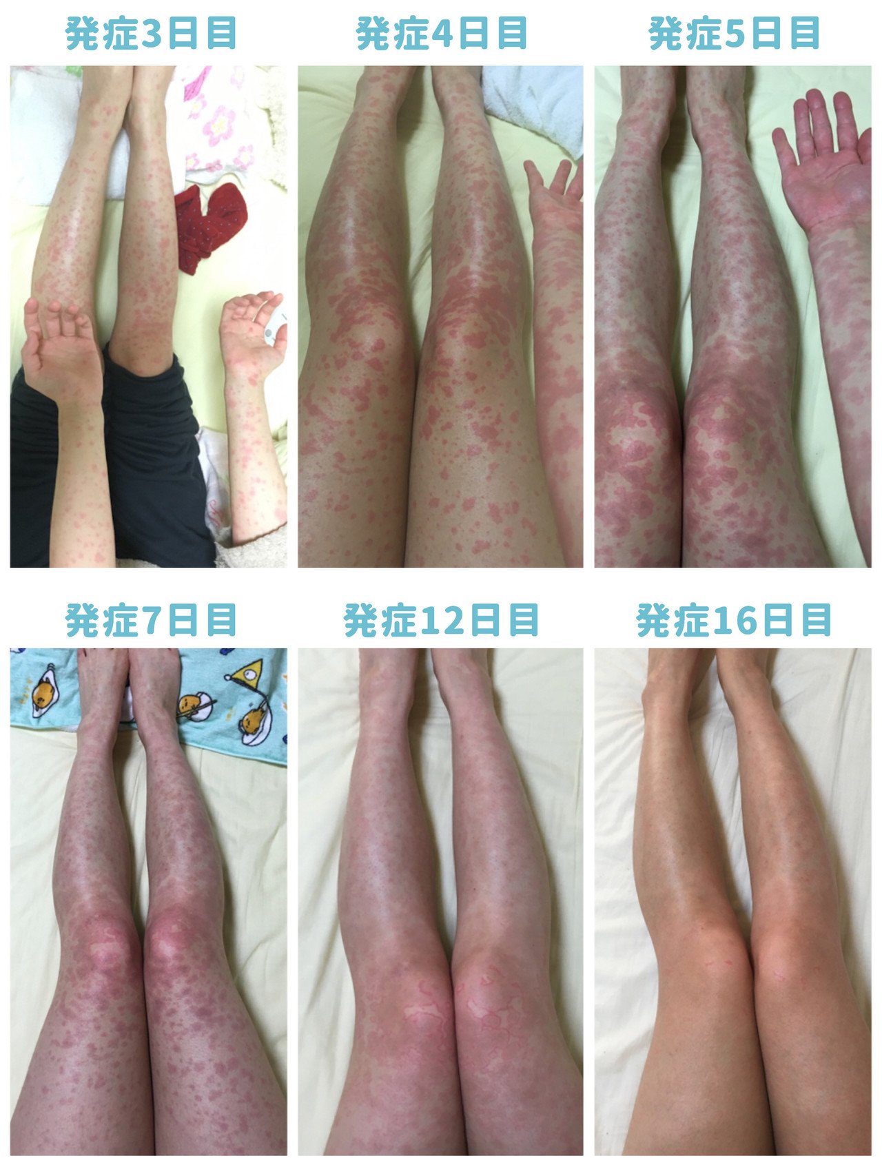 ピロリ菌除菌薬による重症薬疹で死にかけたお話 わなみん Note